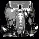 Lymphoma of parotid gland, lymphadenopathy: CT - Computed tomography